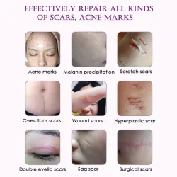 Scar removal & acne treatment - lavender massage oil 10 mlMassage