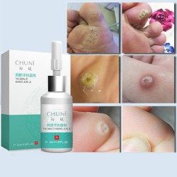 Mole Skin Tag Repair Solution Painless Mole Skin Dark Spot Repair Face Wart Tag Freckle Repair Cre