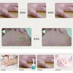 Mole Skin Tag Repair Solution Painless Mole Skin Dark Spot Repair Face Wart Tag Freckle Repair Cre