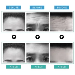 Removal Anti-wrinkle Stickers - Anti-aging - Lifting MaskSkin
