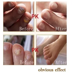 Chinese medicine - nail repair for onychomycosis - nail fungus - 10 mlTreatment