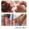 Chinese medicine - nail repair for onychomycosis - nail fungus - 10 mlTreatment