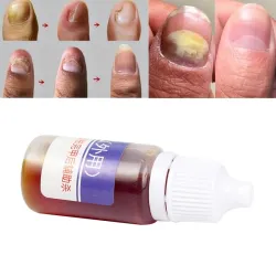 Chinese medicine - nail repair for onychomycosis - nail fungus - 10 mlTreatment