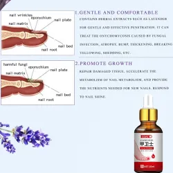 Toenail fungus removal gel - serum - anti infection / paronychia / onychomycosis - 10mlTreatment