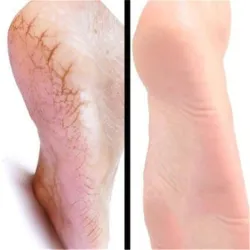 Horse oil ointment - hand / foot repair cream - moisturizerSkin