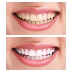 Silicone cosmetic denture - upper / lower bracesTeeth Whitening