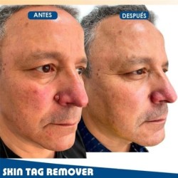 Skin tag / wart remover - serum - 20 mlSkin
