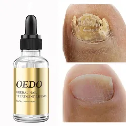 Nagelpilzbehandlung - ätherisches Öl