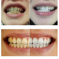 Teeth whitening water 10 mlMouth